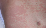 Isso ocorre porque a febre maculosa pode ser confundida com outras doenças chamadas exantemáticas, que causam febre, dores no corpo, cansaço e manchas avermelhadas na pele (exantema maculopapular), como leptospirose e dengue, por exemplo