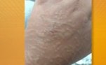 As lesões de pele podem, inclusive, ser o único sintoma da covid. Como é o caso do popularmente chamado 'dedo de covid-19'
