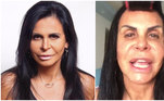 Gretchen fala abertamente sobre as intervenções estéticas que realizou e até rebateu críticas sobre a aparência. A eterna  rainha do bumbum também mostra a 'cara limpa' com frequência no perfil dela no Instagram