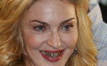 Em agosto de 2013, a cantora Madonna não perdeu a chance de aderir à moda e apostou em uma versão menos usual em que os dentes são contornados pelo metal. Se você acha que já viu isso antes, não está enganado. A prática das capas de ouro surgiram nos anos 1980 e podem ser tanto fixos ou móveis 