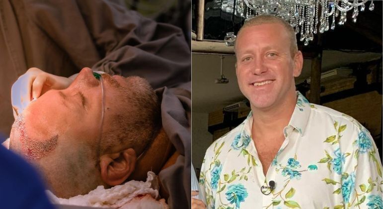 O ator Sérgio Hondjakoff se submeteu ao processo de transplante capilar em 2022. Conhecido por papéis como o Cabeção de Malhação, o ator, de 37 anos, passou por uma cirurgia de 10 horas para dar fim à calvície