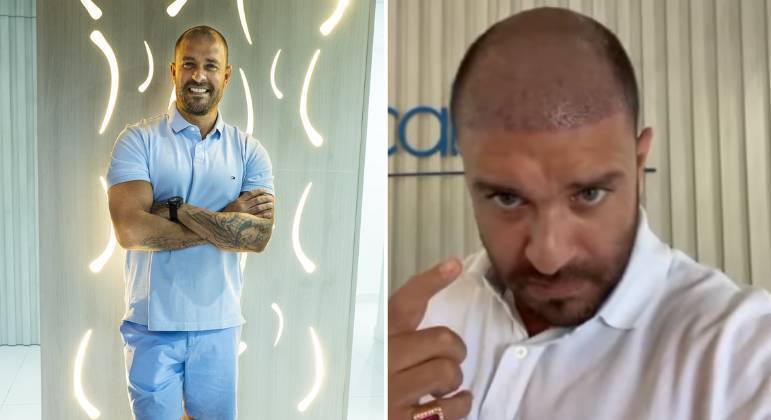 Diogo Nogueira é mais um artista que realizou o procedimento. Na época em que fez o implante, o sambista exibiu o antes e depois nas redes sociais e quis saber dos seguidores se já era possível notar a diferença no visual