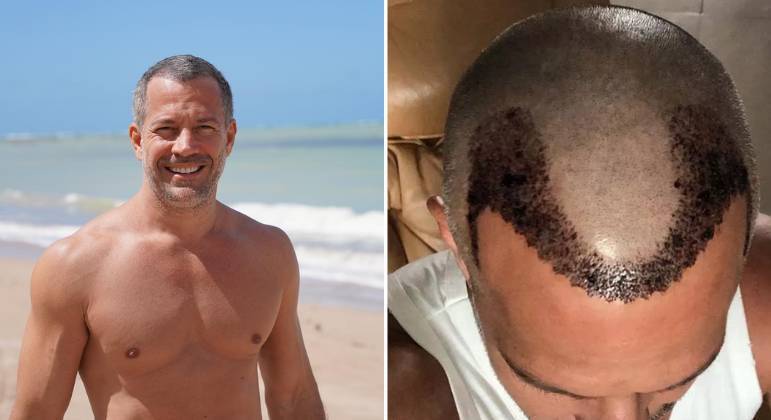 O ator Malvino Salvador passou pelo mesmo tratamento em 2021. 