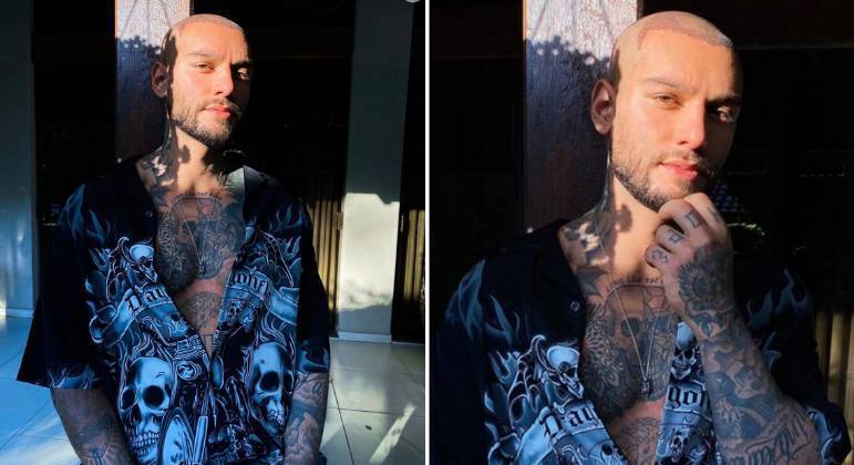 Lucas Lucco passou pela cirurgia em 2020, bem quando houve um aumento no número de homens em busca do procedimento. 