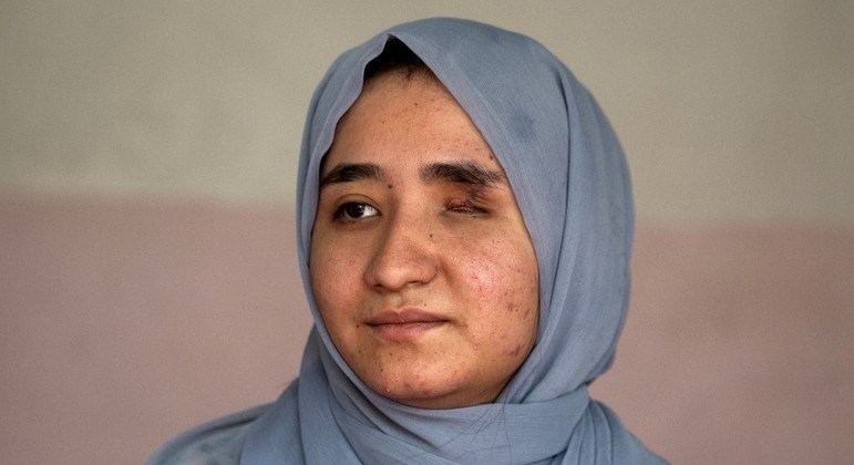 Fatima Amiri ficou cega de um olho e surda de um ouvido após atentado