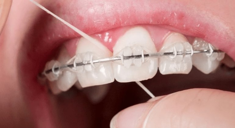 Fio dental - como usar corretamente e quais os principais tipos