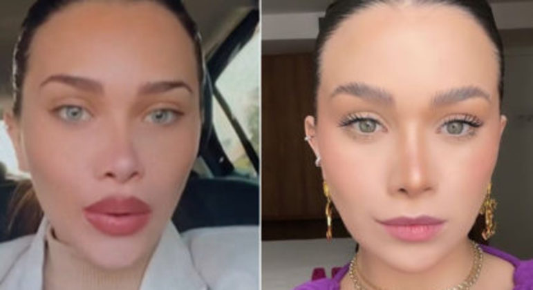 Flavia Pavanelli antes e depois de remover o preenchimento labial