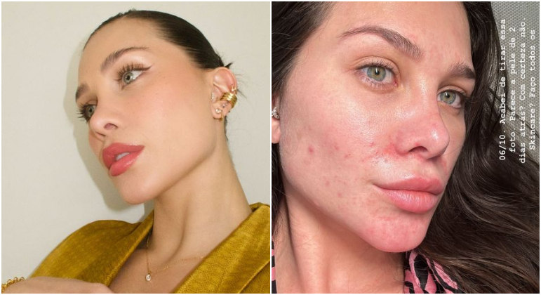 Flavia Pavanelli mostra a pele com poucos dias de diferença