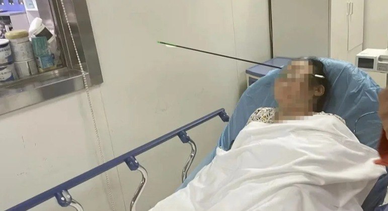 Mulher é atingida no rosto por flecha de 70 cm na China 