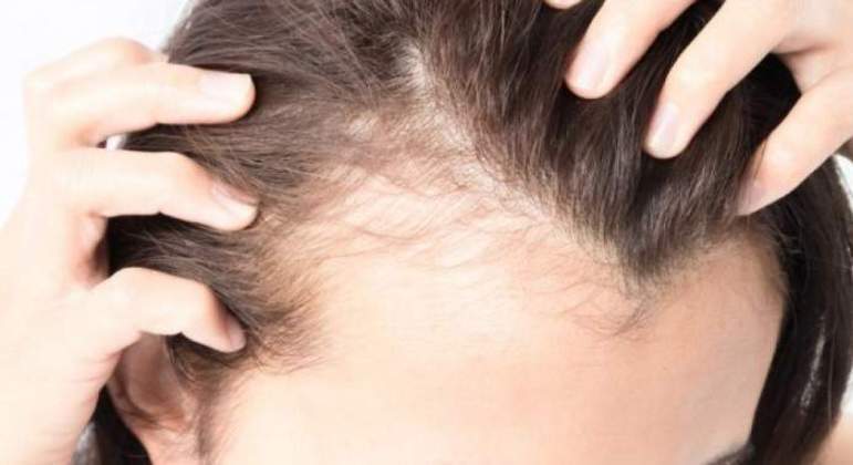 Cabelo caindo em excesso? Conheça 15 causas! - Capellux