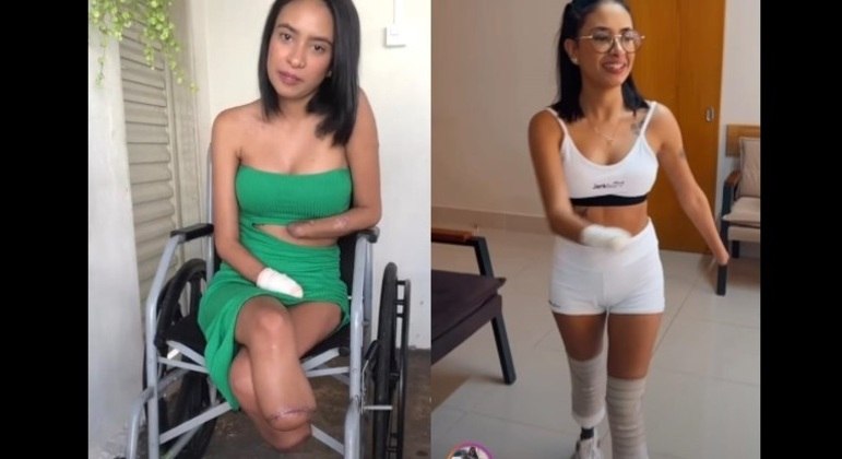 Gabrielle antes e depois de receber as próteses