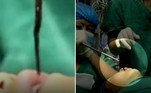 Um garotinho com 5 anos de idade teve uma sanguessuga removida ainda viva da traqueia, no Hospital Popular do Condado de Shuangjiang, na China