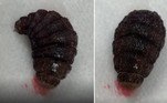 Mesmo após o término do procedimento, a enorme larva continuou a ser contorcer sobre uma bandeja de coletaVeja também: Onda sinistra desafia surfistas na Austrália: 'Pode ser vida ou morte'