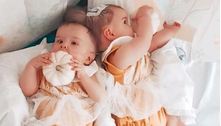 Médicos separam gêmeas que nasceram com as cabeças grudadas