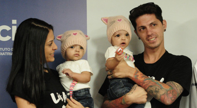As siamesas Mel e Lis receberam alta poucos dias após completarem 1 ano