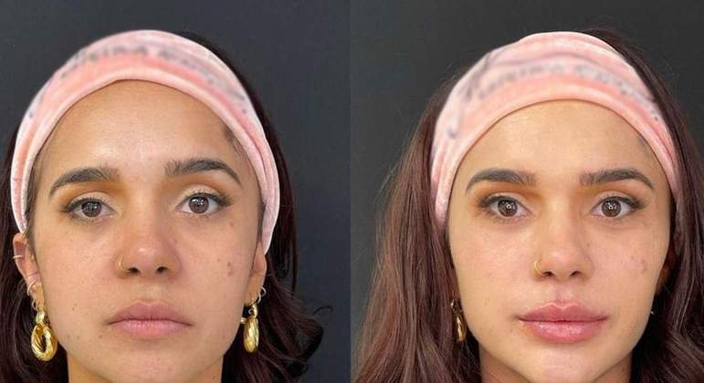 Gizelly Bicalho se submeteu a procedimentos de preenchimento e aplicação de fios de PDO para manter o rosto jovem em fevereiro deste ano e impressionou os internautas com as mudanças. 'Irreconhecível', escreveu um usuário do Twitter. 'A Gizelly ficou com as maçãs do rosto mais preenchidas, deixando o visual mais feminino, e a leve arqueada nas sobrancelhas deixou o olhar mais poderoso. O preenchimento com ácido hialurônico, inclusive, estimula a produção de colágeno no local da aplicação, ajudando na prevenção dos sinais de envelhecimento da pele', explicou Larissa Lima, que realizou o procedimento