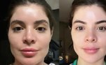 A moda agora é ter uma beleza natural. Por isso, cada vez mais celebridades estão revertendo procedimentos estéticos que até pouco tempo atrás estavam em alta. Gkay puxa a lista de famosos que resolveram recuperar os traços naturais do rosto. Recentemente, a influenciadora e comediante removeu o preenchimento que tinha na região dos malares. Além disso, ela já havia retirado o preenchimento labial