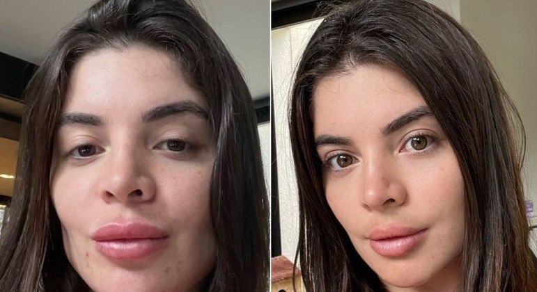 Gkay antes e depois de retirar o preenchimento labial