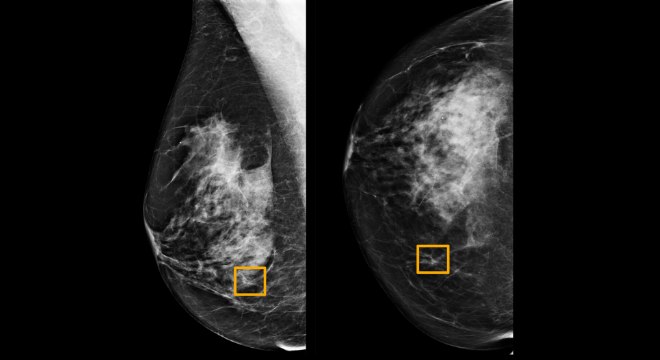 Radiologistas tendem a não detectar cerca de 20% dos casos de câncer de mama