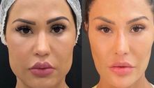 Gracyanne Barbosa mostra antes e depois do rosto após procedimentos estéticos