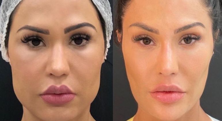 Gracyanne Barbosa mostra antes e depois de procedimentos no rosto