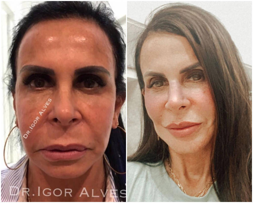 Veja O Antes E Depois De Famosos Que Fizeram Harmonizacao Facial Fotos R7 Famosos E Tv
