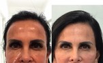 Bem-resolvida, Gretchen não esconde os procedimentos estéticos que realiza. Na foto acima, é possível ver seu antes e depois de passar por uma harmonização facial — tratamento que ela já retocou algumas vezes. Com frequência, a eterna rainha do rebolado (e dos memes) vira assunto nas redes sociais por causa de sua aparência, mas não deixa de rebater as críticas que recebe. 'Teve comentários ridículos sobre minha manutenção de harmonização. Sabe o que acontece? Estou bloqueando geral [...]. Toda manutenção tem seu tempo de recuperação. E quem não entende isso tem que ser bloqueado. Está inchado porque acabei de fazer', retrucou em um de seus momentos de desabafo. Veja também: De harmonização a barriga sarada: as polêmicas estéticas de Gretchen