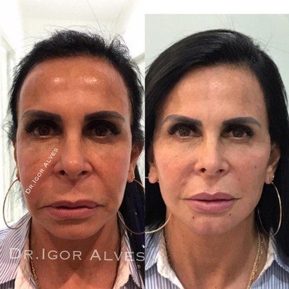 Bem-resolvida, Gretchen não esconde os procedimentos estéticos que realiza. Na foto acima, é possível ver seu antes e depois de passar por uma harmonização facial — tratamento que ela já retocou algumas vezes. Com frequência, a eterna rainha do rebolado (e dos memes) vira assunto nas redes sociais por causa de sua aparência, mas não deixa de rebater as críticas que recebe. 'Teve comentários ridículos sobre minha manutenção de harmonização. Sabe o que acontece? Estou bloqueando geral [...]. Toda manutenção tem seu tempo de recuperação. E quem não entende isso tem que ser bloqueado. Está inchado porque acabei de fazer', retrucou em um de seus momentos de desabafo. Veja também: De harmonização a barriga sarada: as polêmicas estéticas de Gretchen