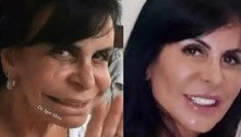 Cirurgia plástica, harmonização: saiba o que é possível deduzir do Imposto de Renda 2023 com estética