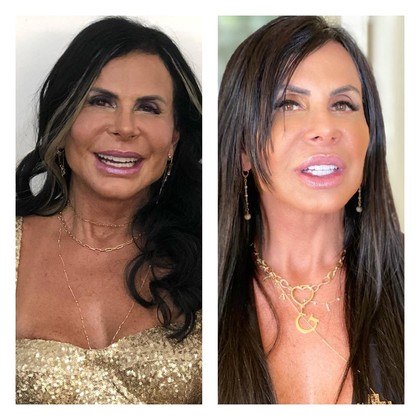 Gretchen não esconde que é fã de harmonização facial. No fim de 2020, ela fez a manutenção do procedimento e rebateu 'opiniões idiotas' sobre como havia ficado sua aparência. 'Teve comentários ridículos sobre minha manutenção de harmonização. Sabe o que acontece? Estou bloqueando geral quem falar merda. Toda manutenção tem seu tempo de recuperação. E quem não entende isso tem que ser bloqueado. Está inchado porque acabei de fazer', afirmou