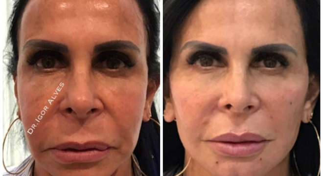 Gretchen mostrou antes e depois da harmonização facial