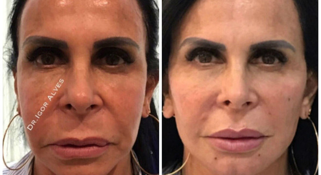 Gretchen mostra antes e depois do procedimento estético