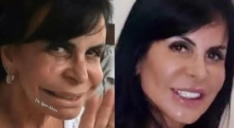 Gretchen antes e depois de fazer harmonização facial ao longo de quatro anos