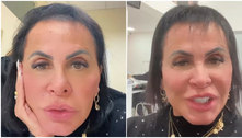 Gretchen mostra resultado de tratamento para alopecia; veja o antes e depois