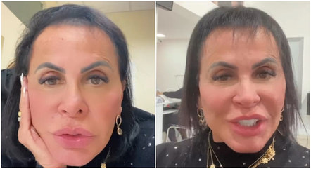 Gretchen está fazendo tratamento para alopecia