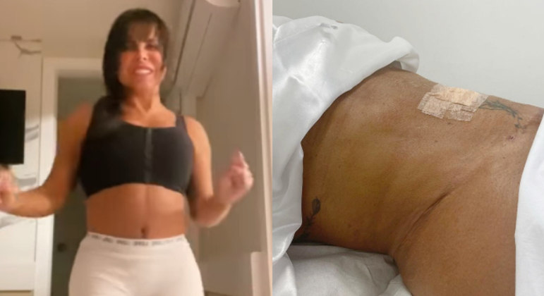 Gretchen mostra resultado de lipo HD
