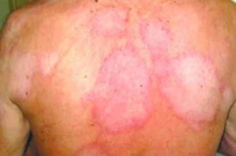 Hanseníase causa manchas na pele