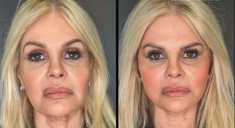 Monique Evans, de 67 anos, fez várias sessões de um tratamento para harmonizar o rosto ao longo deste ano. A primeira sessão foi realizada em junho. 