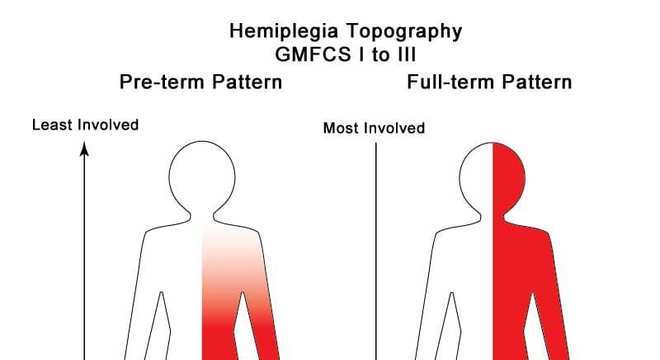 Hemiplegia, o que é? Causas, classificações, sintomas e tratamento