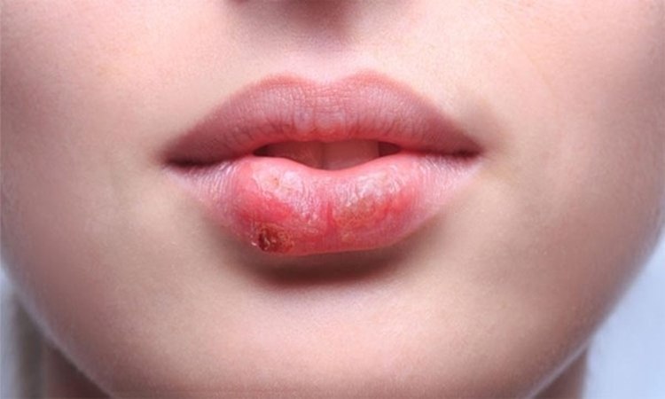 Herpes Zoster E Mais Comum Em Idosos Devido A Queda Da Imunidade Noticias R7 Saude