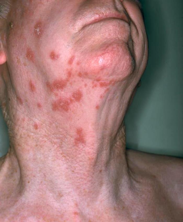 Herpes Zoster E Mais Comum Em Idosos Devido A Queda Da Imunidade Noticias R7 Saude