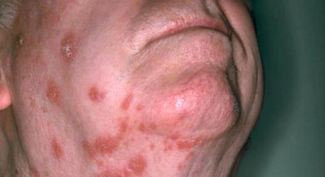 A herpes zoster se caracteriza por lesões avermelhadas seguidas de vesículas 