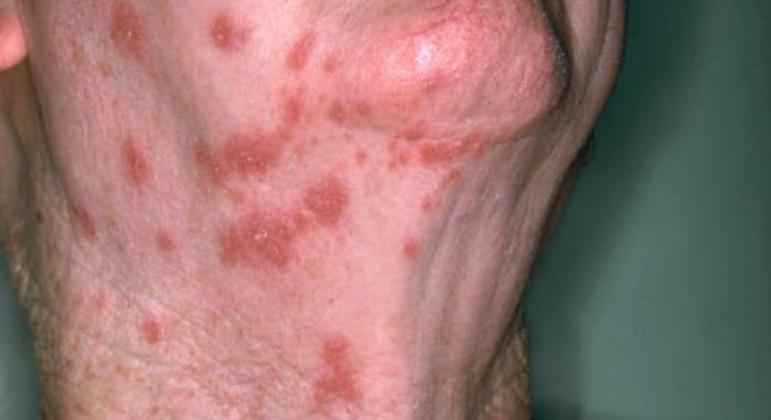 Doença se caracteriza por manchas na pele e dor