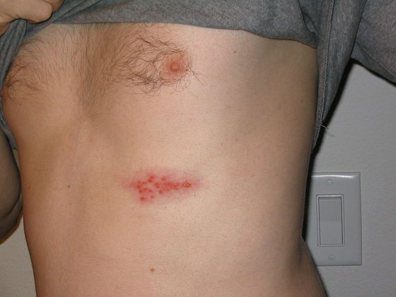 Herpes-zósterDe acordo com o NHS, o herpes-zóster, também conhecido popularmente como cobreiro, é uma doença que causa erupção cutânea dolorosa, normalmente em um lado do corpo, na região do peito ou da barriga. É provocada pelo mesmo vírus da catapora, que fica adormecido no corpo