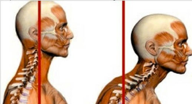 Hipercifose
