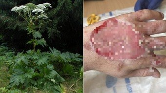 A highly toxic plant leaves a young man with giant blisters on his hand