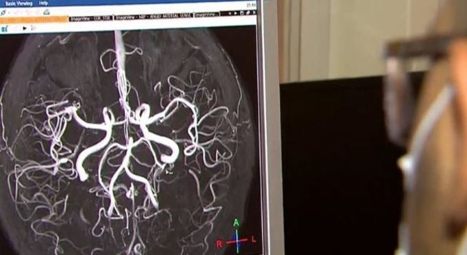 Covid-19 deixa sequelas neurológicas em um terço dos pacientes curados 