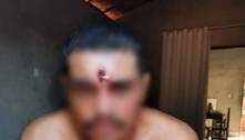 Homem é baleado na testa, vai para casa, dorme e depois recebe atendimento médico no Tocantins