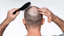 Cientistas descobrem como estresse causa perda de cabelo 