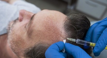 Homens apostam em tratamentos contra queda de cabelo